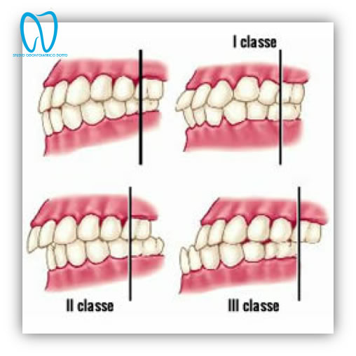 malocclusione dentale 